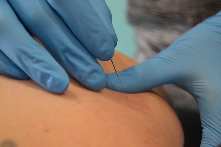 Aplicación de punción seca en la espalda en la clínica de fisioterapia de Lugo