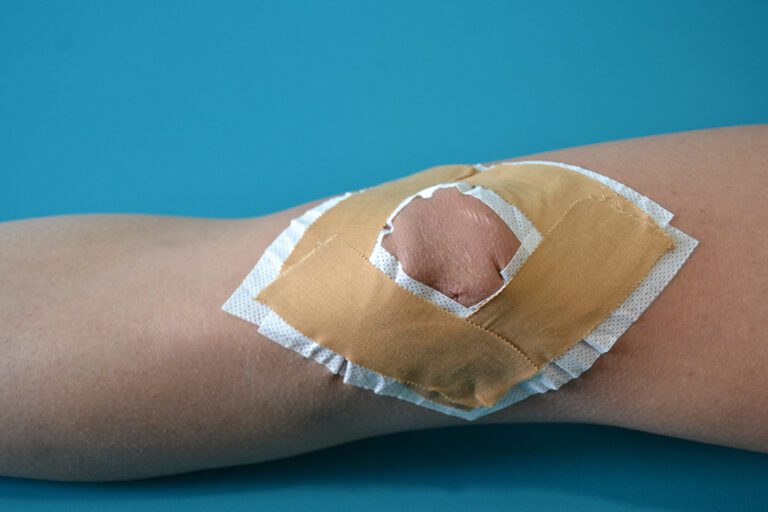 Vendaje rotuliano McConnell aplicado en la rodilla