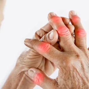 Foto de dedos con artrosis