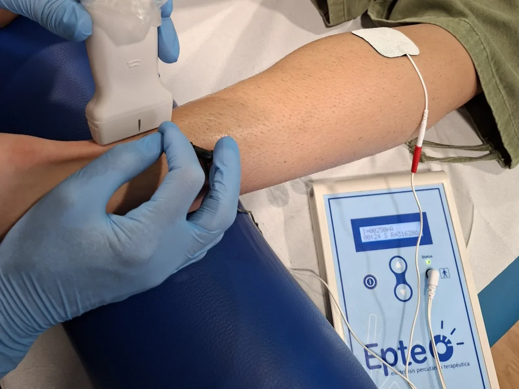 Tratamiento de EPTE guiado por ecografía en la clínica de fisioterapia de Lugo