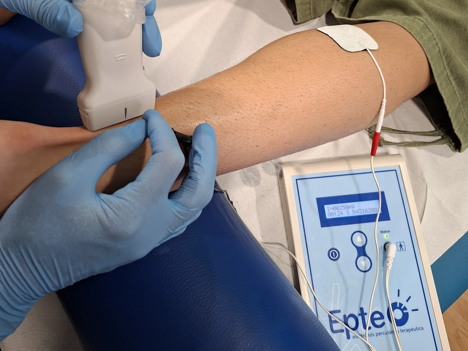 Tratamiento de EPTE guiado por ecografía en Lugo