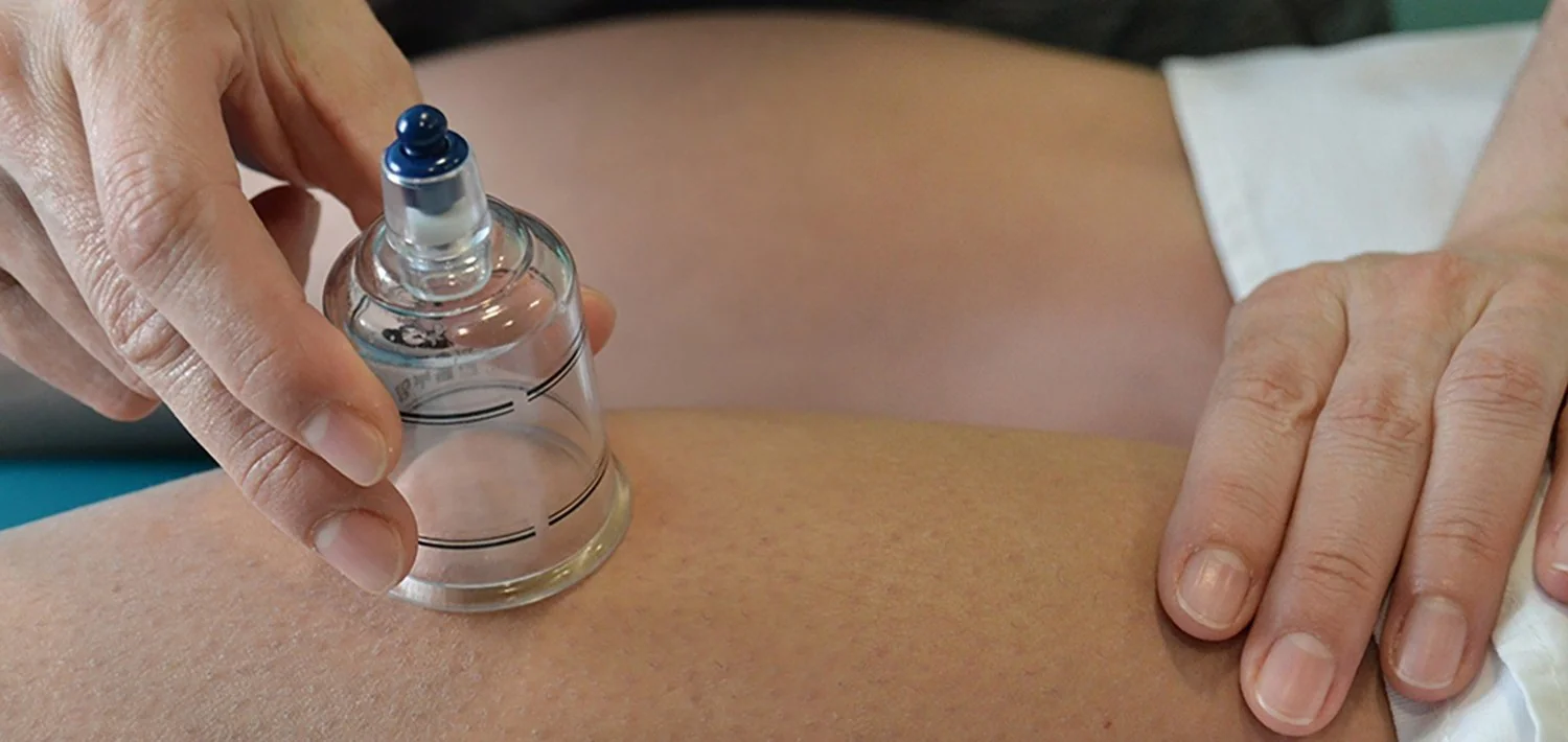 Aplicación de ventosas sobre la espalda en la clínica de fisioterapia de Lugo