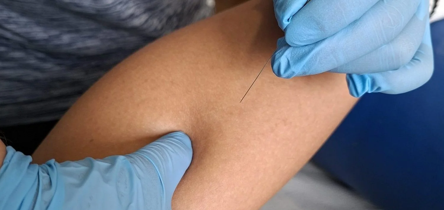 Fisioterapeuta aplicando punción seca en el gemelo de un deportista en Lugo