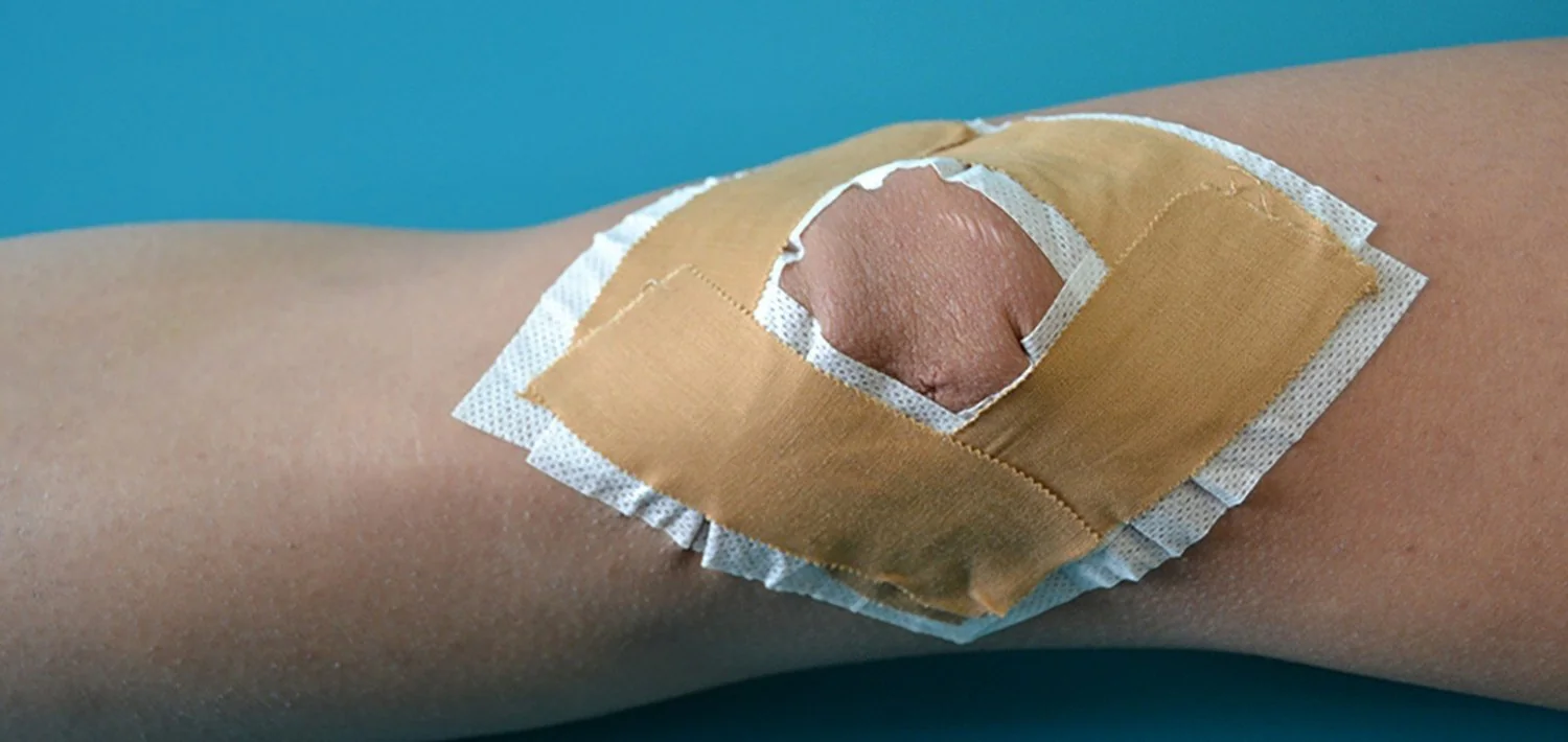 Rodilla con vendaje McConnell colocado tras una intervención